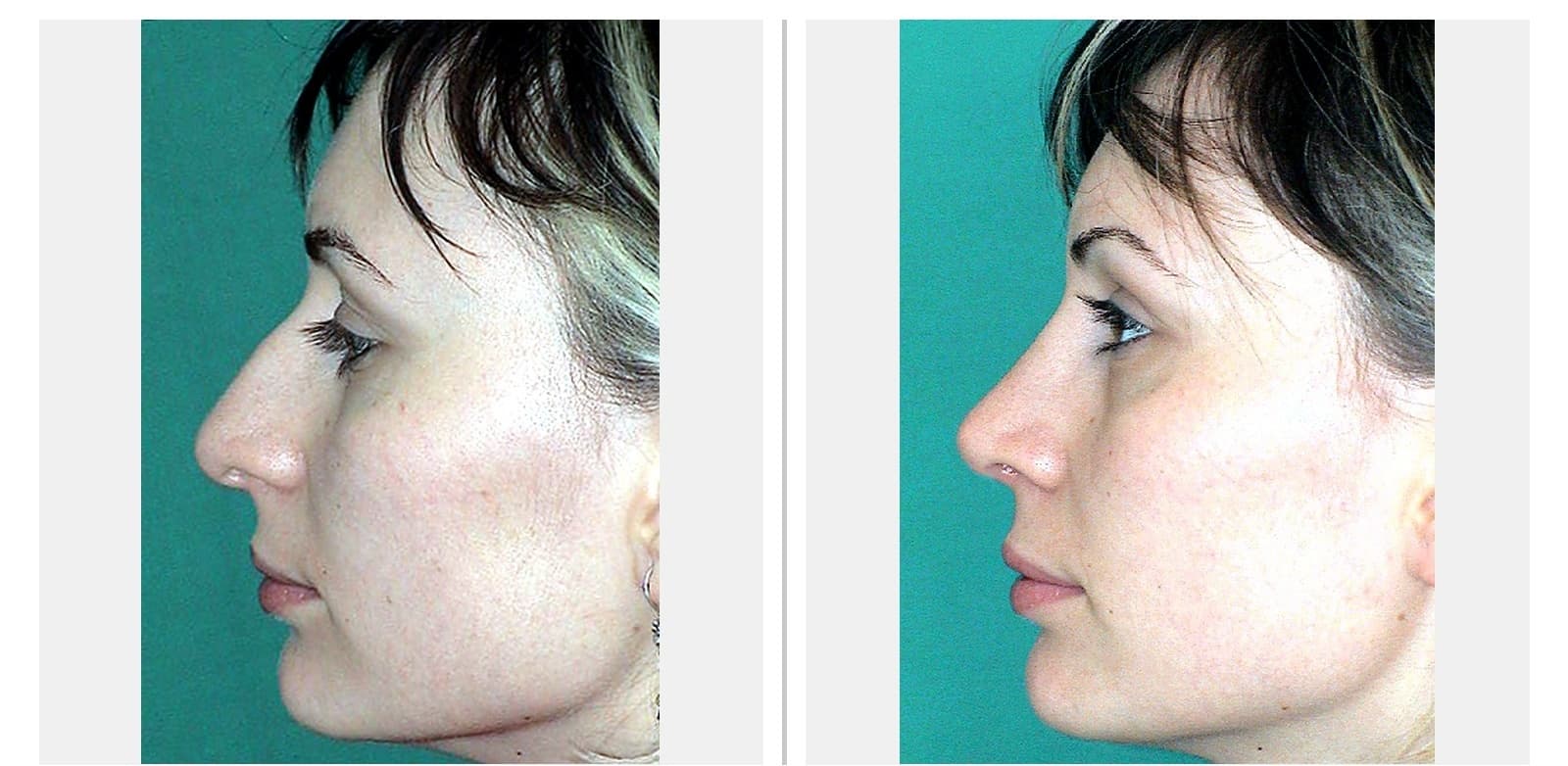 Rhinoplasty before and after — Clinical case 1