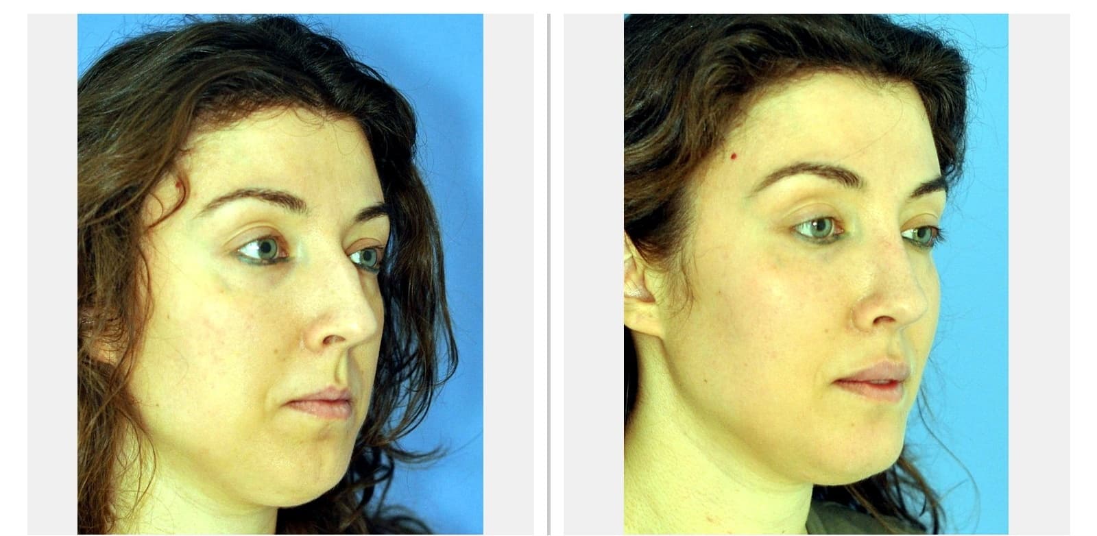Rhinoplasty before and after — Clinical case 25