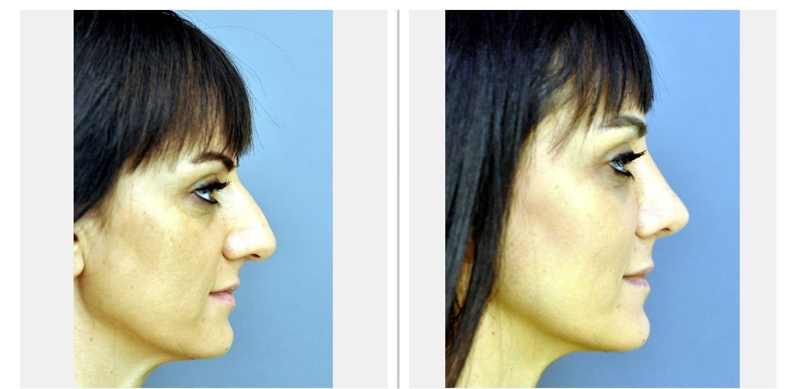 Rhinoplasty before and after — Clinical case 28