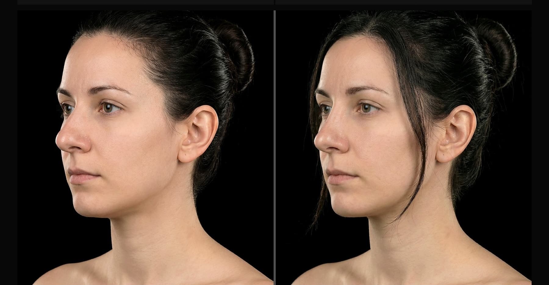 Rhinoplasty before and after — bridge narrowing