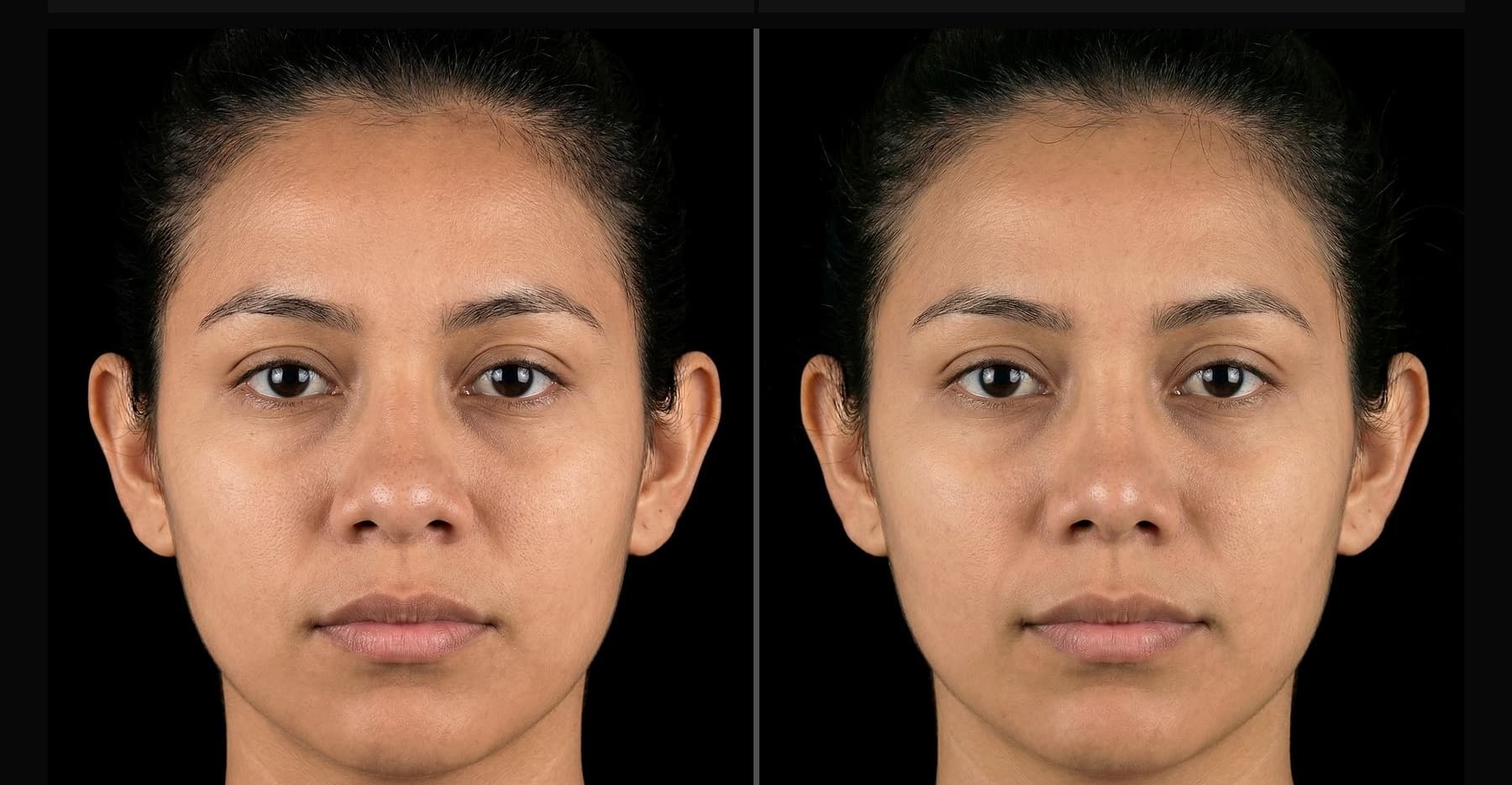 Rhinoplasty before and after — Case 25