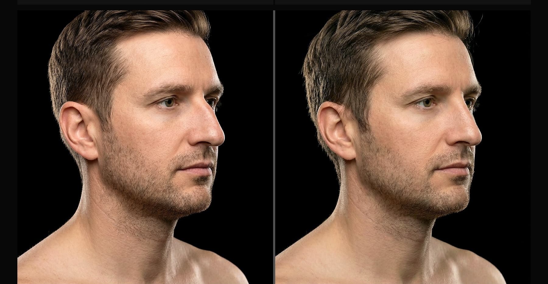 Rhinoplasty before and after — Case 50