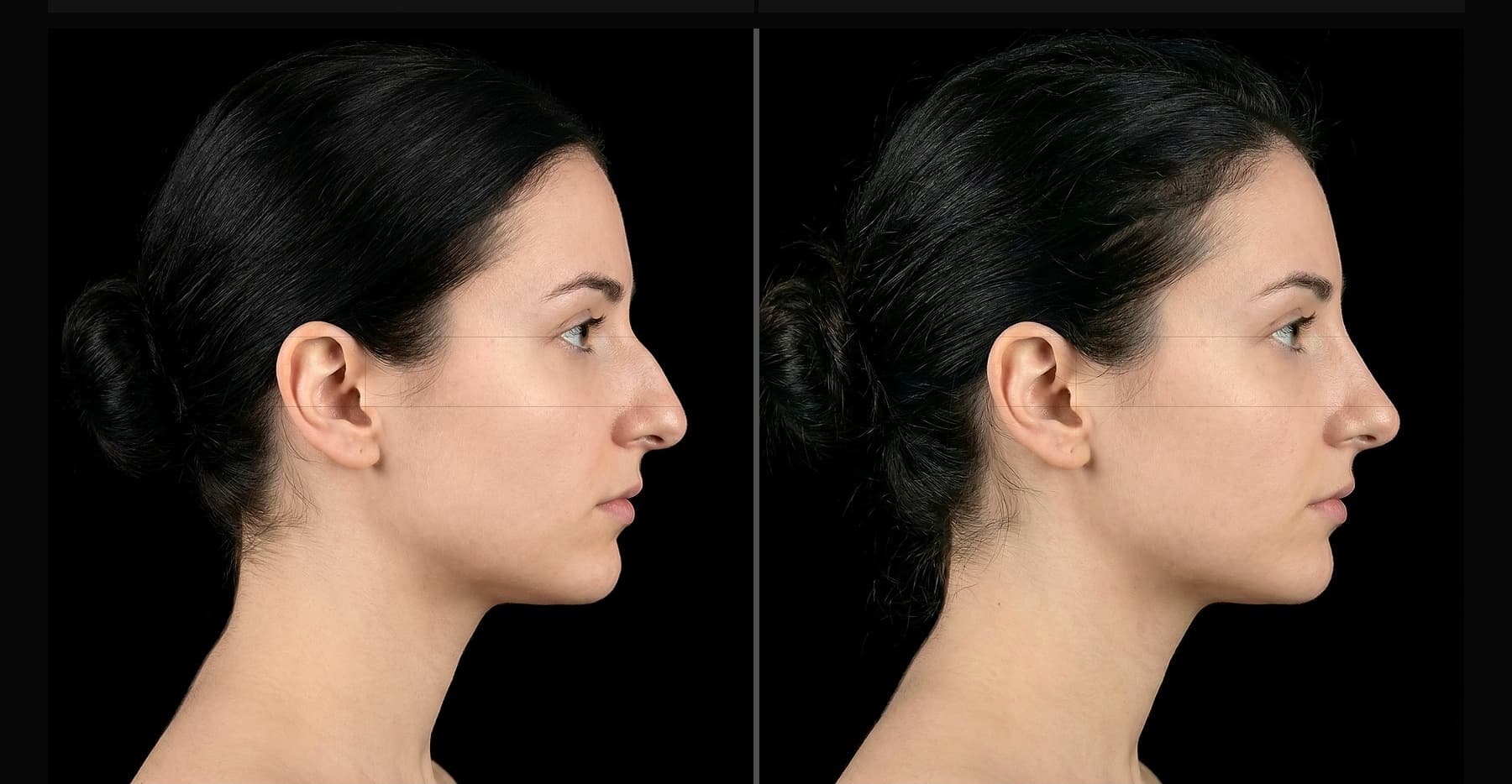 Rhinoplasty before and after: case 1