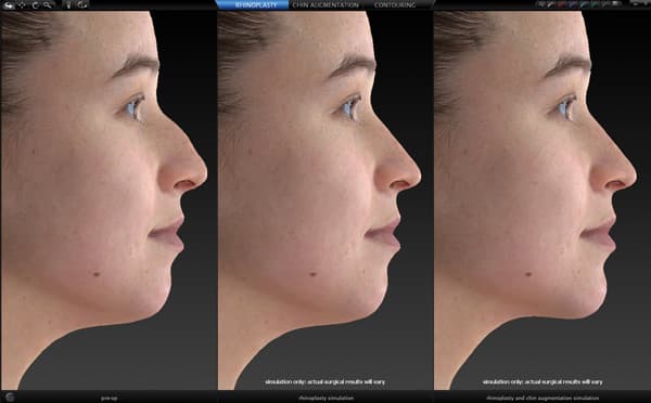 Vectra H2 3D imaging system showing a simulated rhinoplasty result