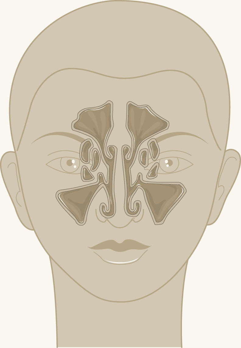 Front view of the face showing the position of the paranasal sinuses: frontal sinuses in the forehead, ethmoid sinuses between the eyes and maxillary sinuses in the cheeks